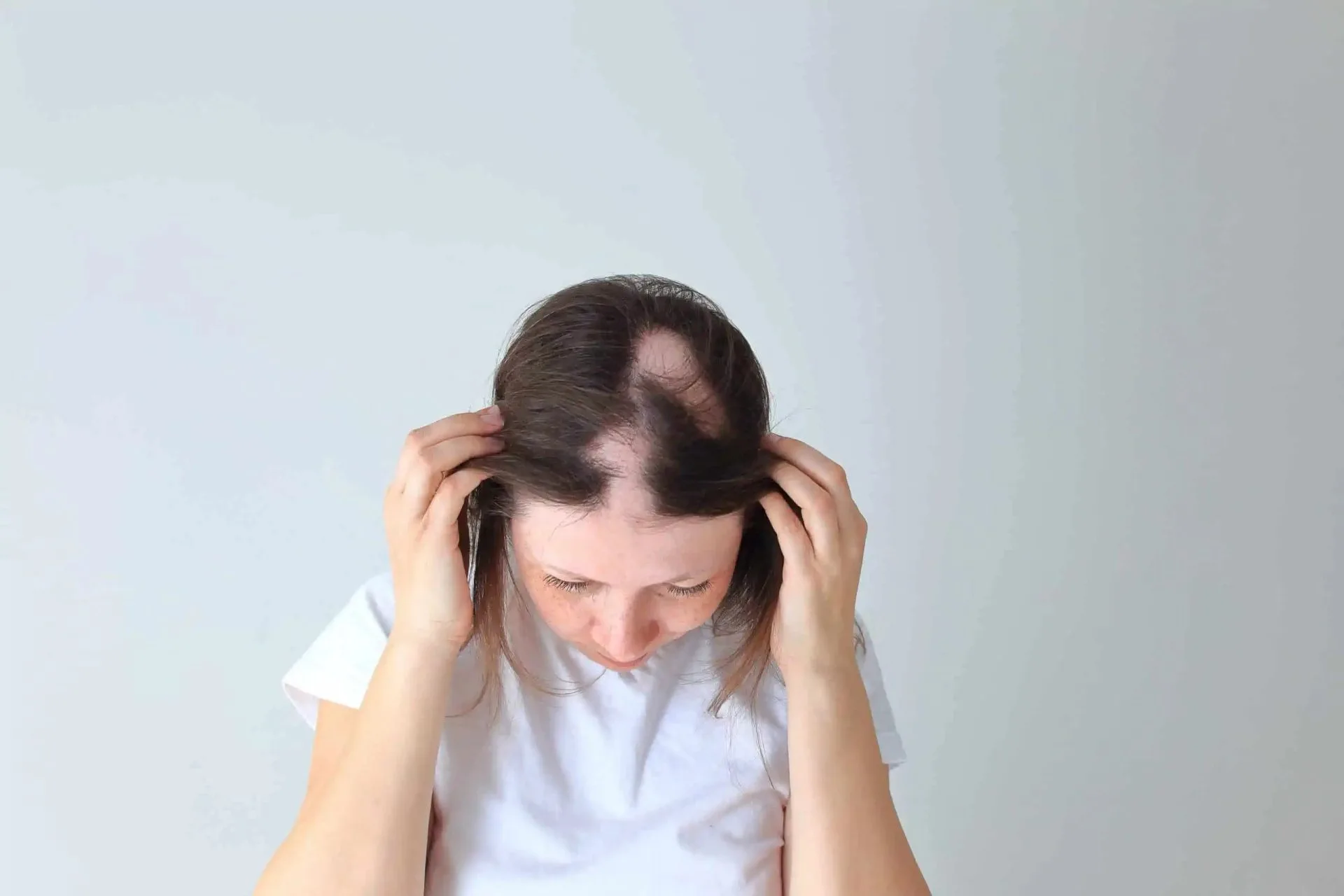 Alopecija areata – uzrok, simptomi i liječenje