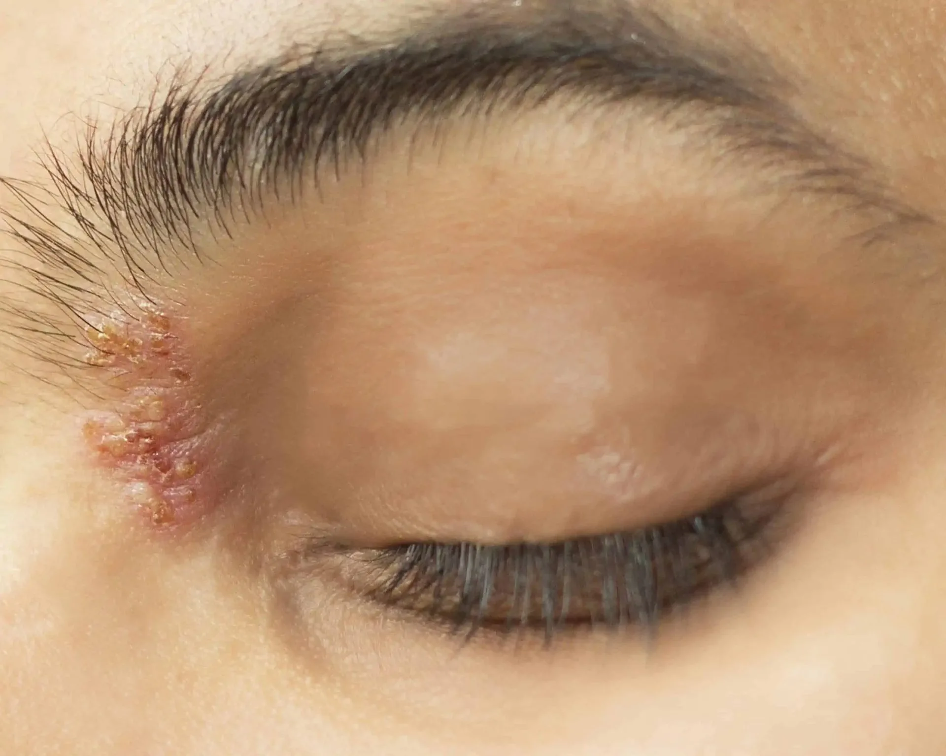 Herpes na oku – uzrok, simptomi i liječenje