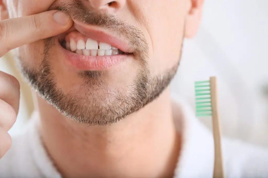 Gingivitis – 10 najčešćih simptoma